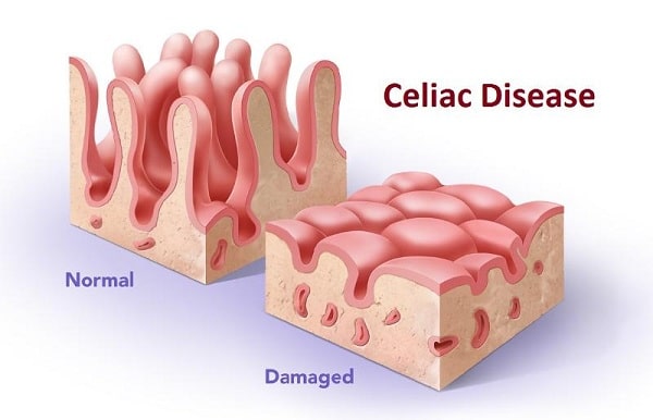 Bệnh celiac ở trẻ nhỏ