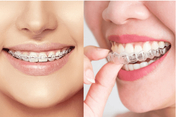 Lời khuyên và hướng dẫn liên quan đến việc niềng răng